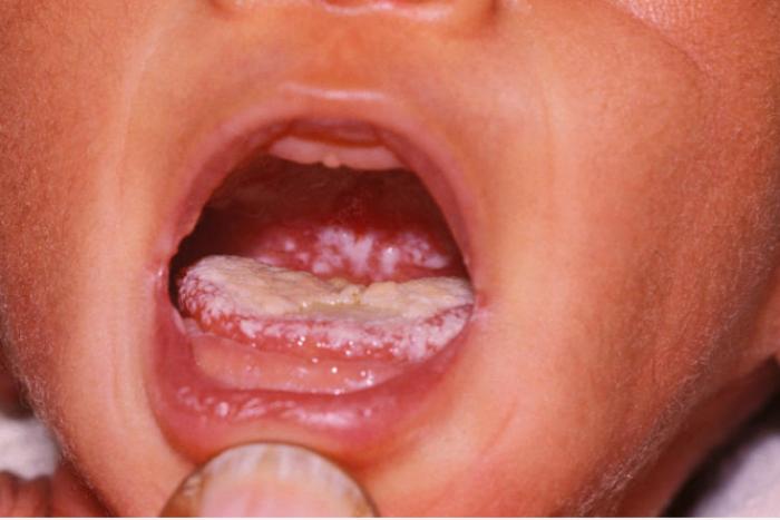 lidah putih akibat jamur kandida