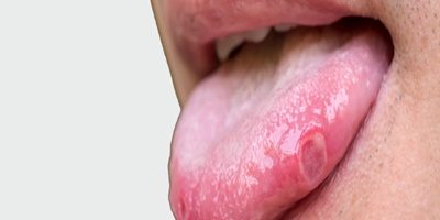 penyebab sariawan di lidah