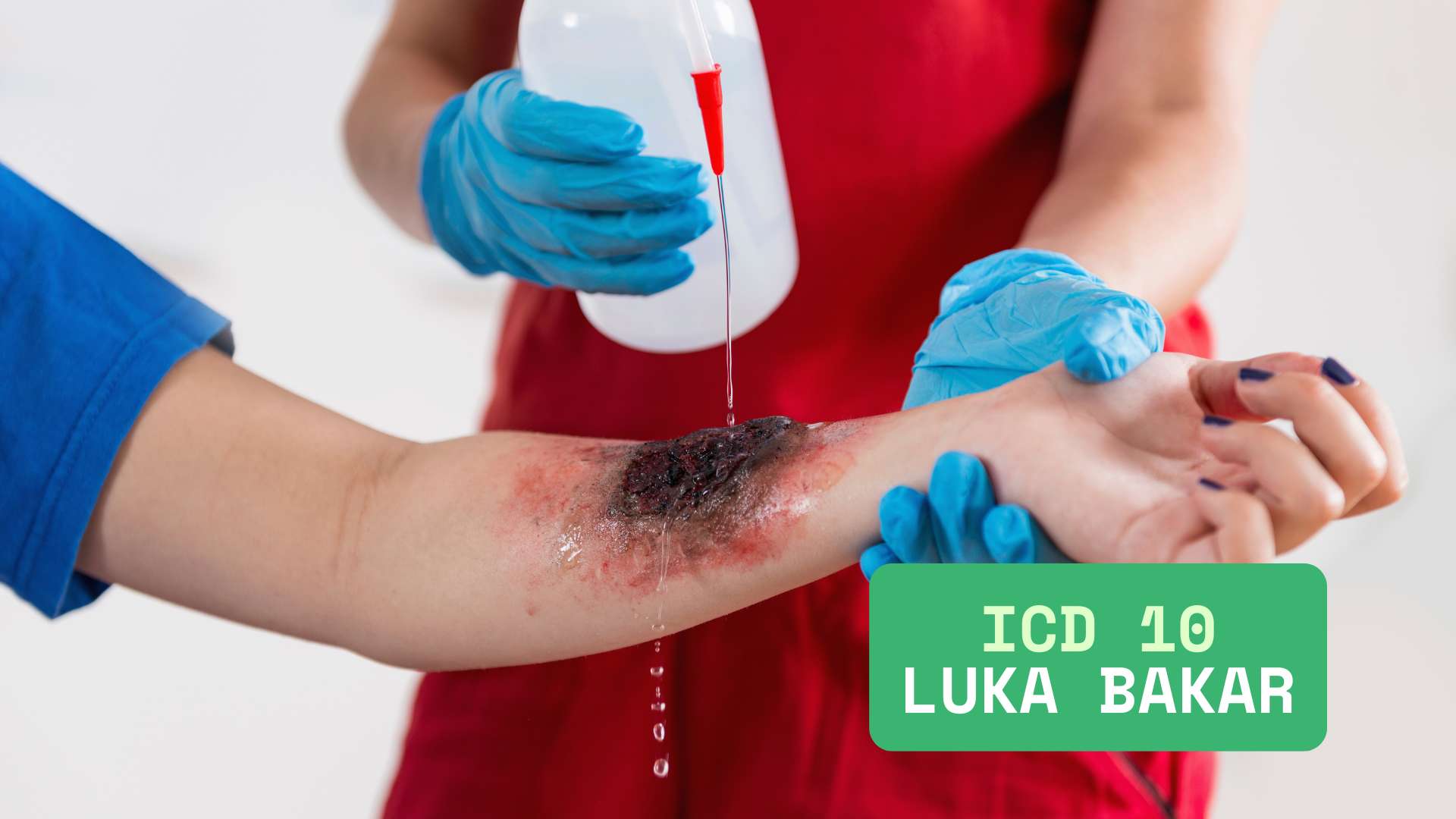 kode icd10 luka bakar